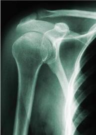 shoulder x-ray