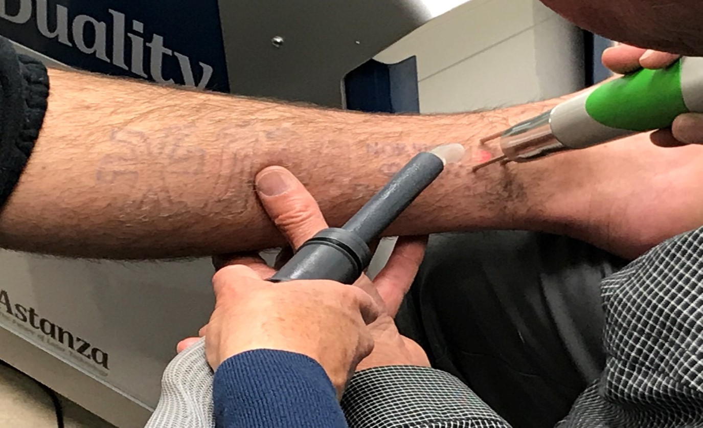 tattoo removal.jpg